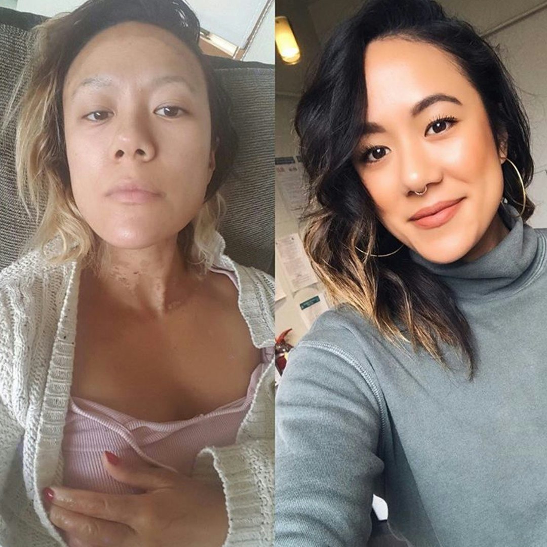 In 2016, Gina Florio suffered burns on her face, hands and upper body after the gas tank on a grill exploded as she lit it. She has since recovered, but the mental healing took time. Photo provided by: Gina Florio